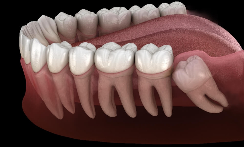 A diagram of a wisdom tooth growth