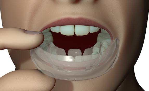 TMJ Appliance Therapy