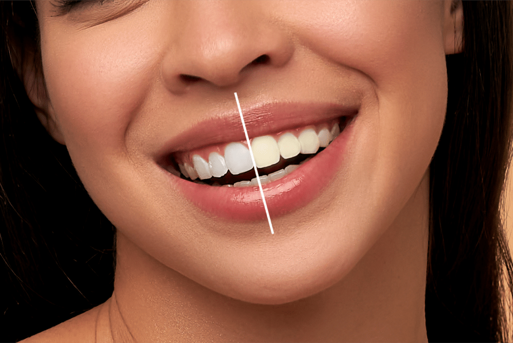 A before and after image of a teeth whitening procedure.