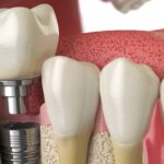 A diagram of a dental implant procedure