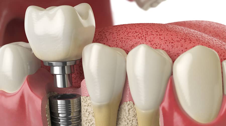 A diagram of a dental implant procedure