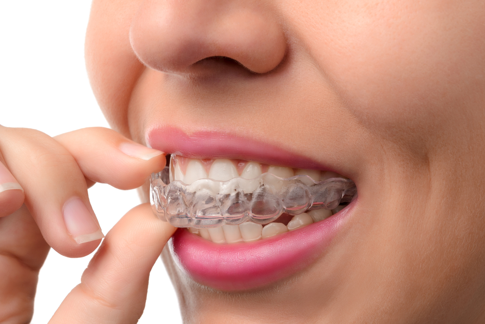 a woman with invisalign