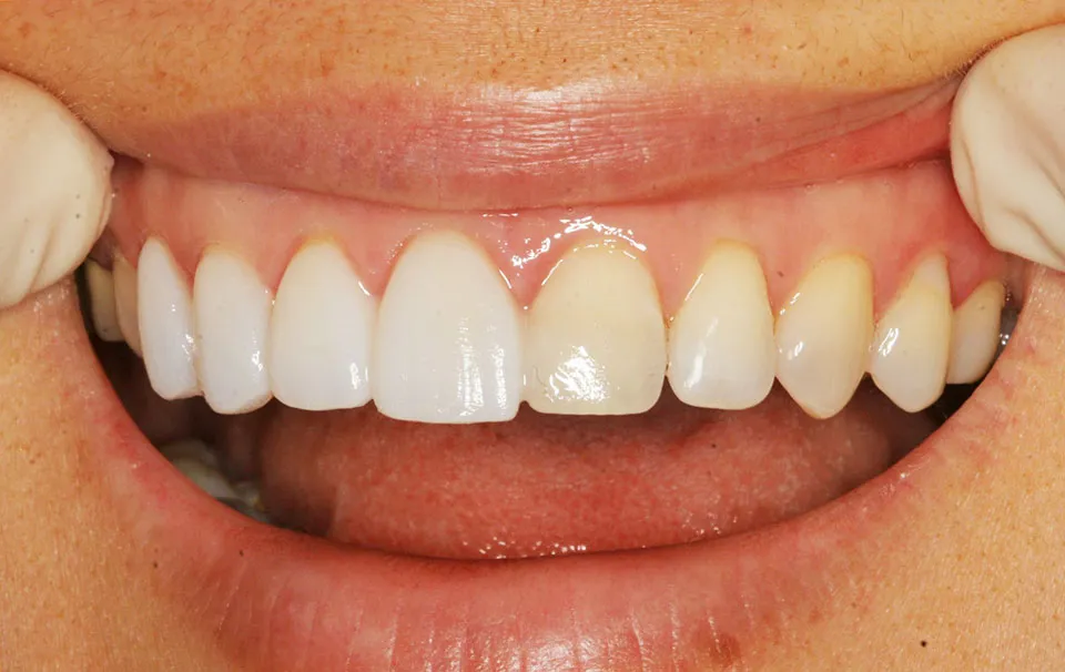 Veneers / Lumineers
