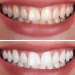 Teeth Whitening