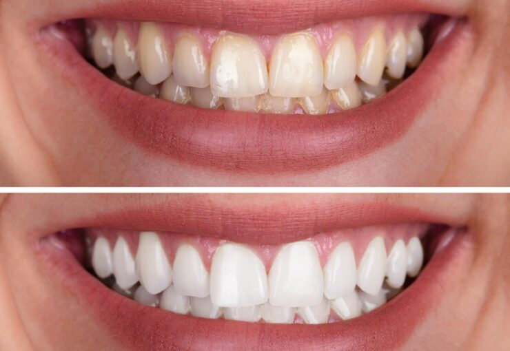 Teeth Whitening