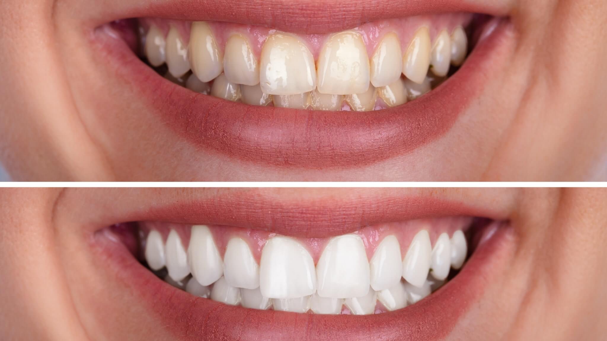 Teeth Whitening