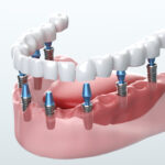 Digital generated image of ceramic dental veneers installation process on white background.